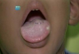 Criança de 4 anos tem língua cortada com faca por professora na BA