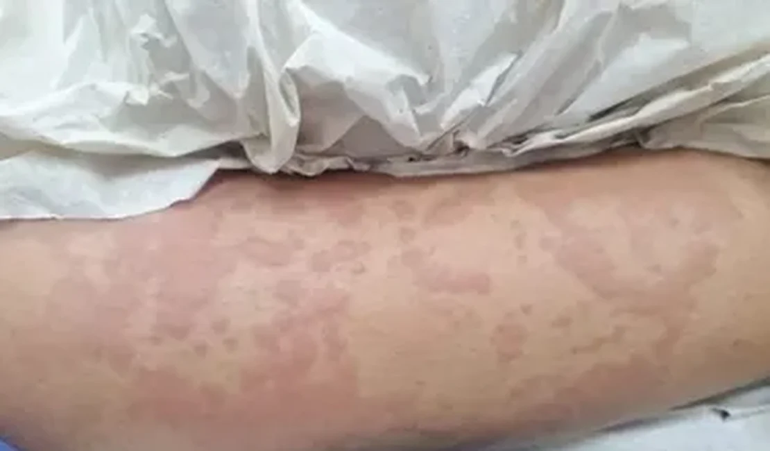 Exame aponta que detergente Ypê não causou doença em menina de 10 anos