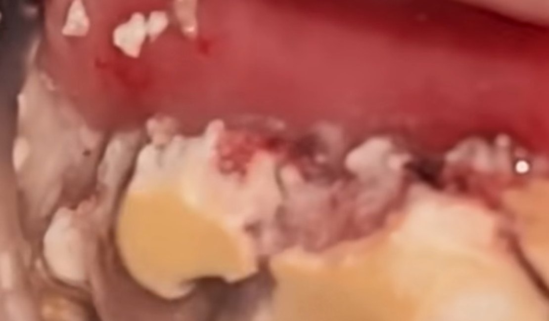 Vídeo impressionante mostra placa gigante de tártaro sendo removida da boca de paciente