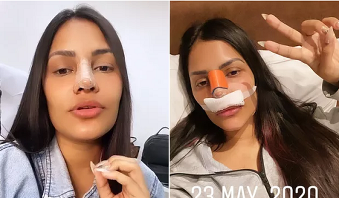 'Adeus 'Facetune', feliz nariz novo', diz Flayslane após rinoplastia