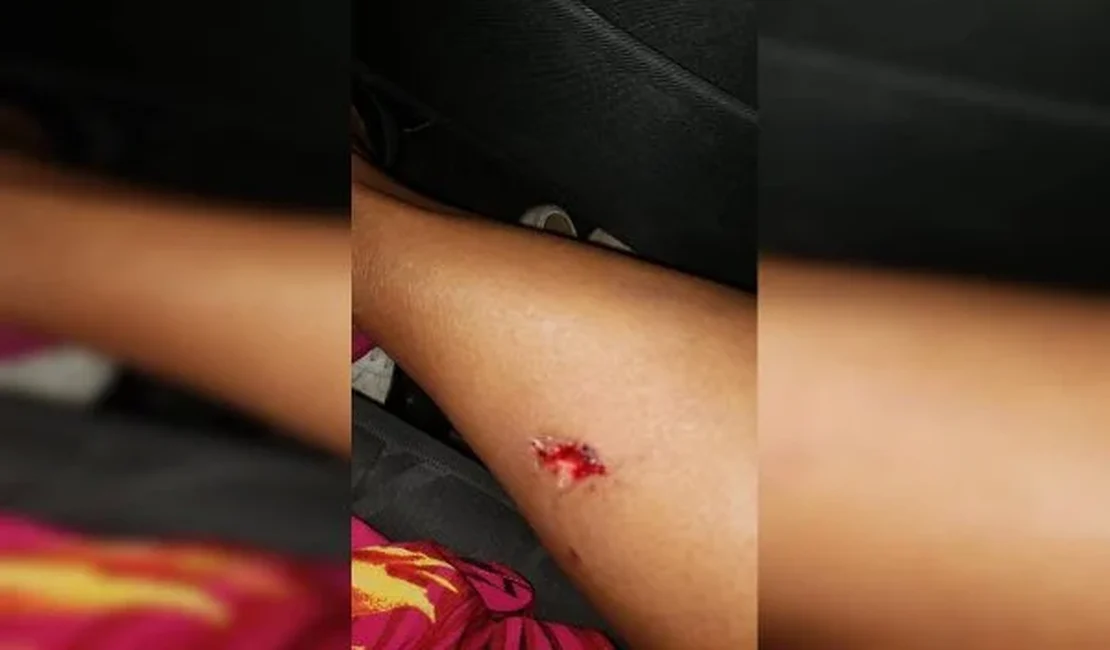 Por rixa antiga, mulher arranca pedaço da perna de rival com dentada: 'Vagabunda, acabou com minha vida na internet'