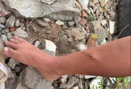 Criança tem perna perfurada por vergalhão enquanto buscava madeira para fogueira, em Arapiraca