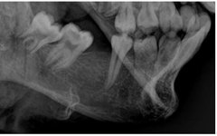 Imagem em alta resolução da arcada dentária feita no scanner de corpos do IML permitiu a identificação do cadáver.