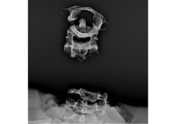 Crânio encontrado em Paripueira é de jovem decapitado, conclui IML