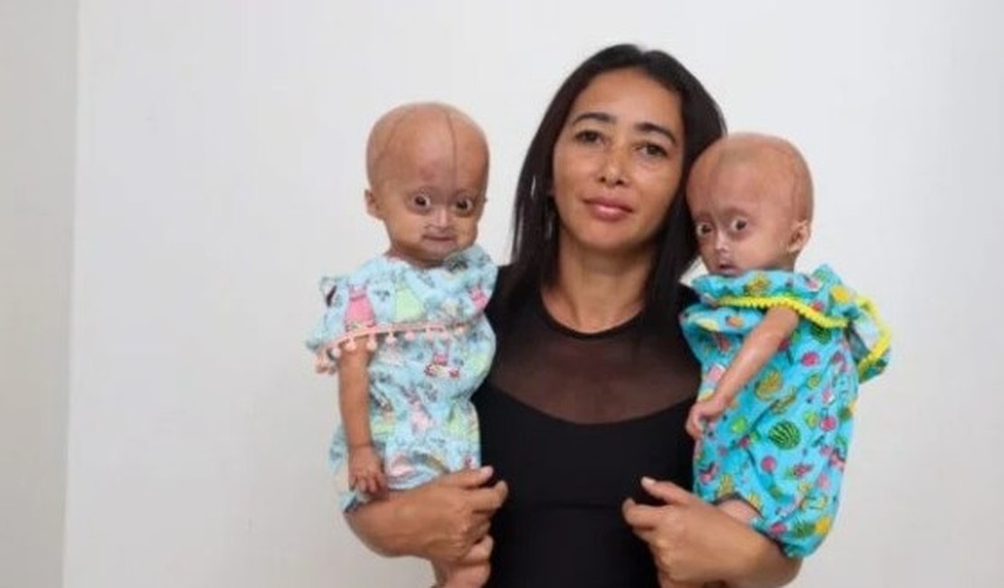 Conheça as gêmeas brasileiras com síndrome de Benjamin Button