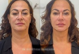 Nadine Gonçalves, mãe de Neymar, surpreende internautas com harmonização facial