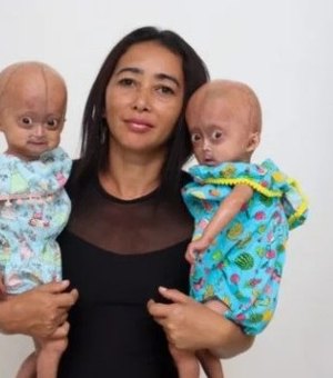 Conheça as gêmeas brasileiras com síndrome de Benjamin Button