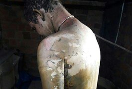 Arapiraquense que teve o corpo queimado está na UTI do HE do Agreste