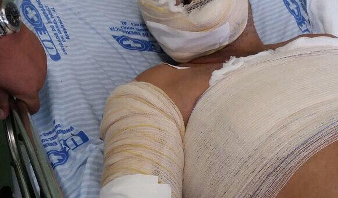 Celular explode e homem fica gravemente ferido no Agreste alagoano