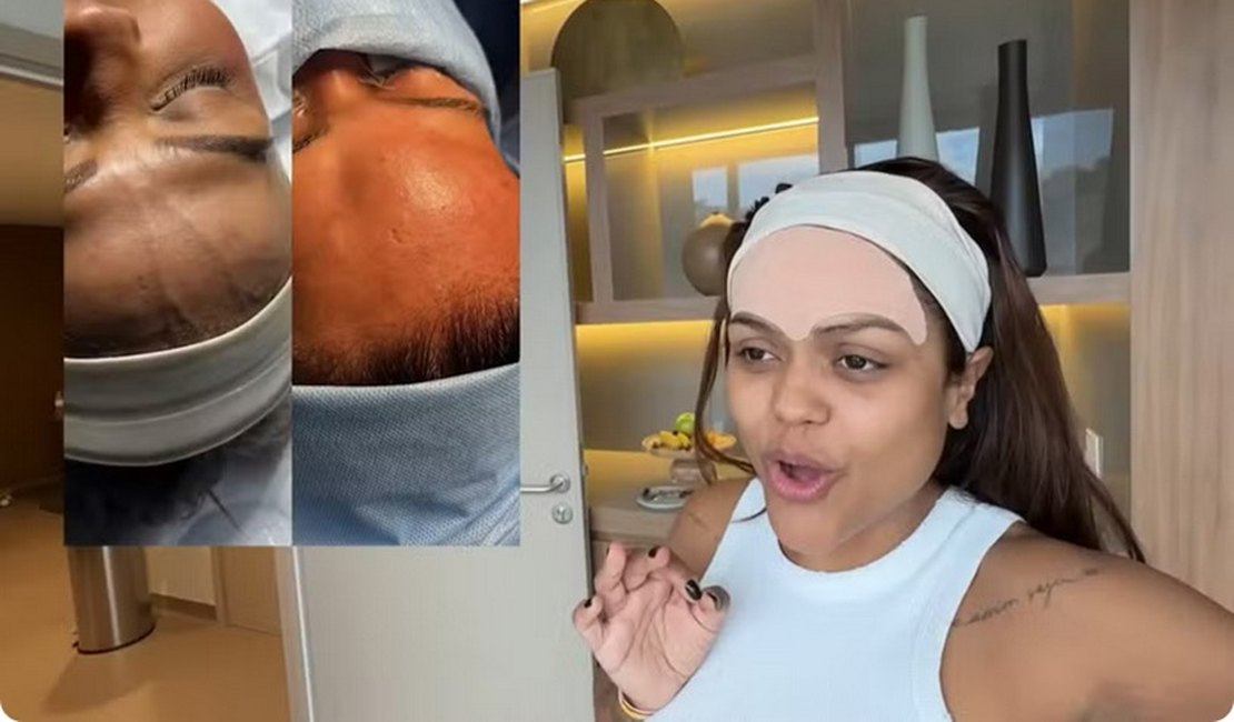 Influenciadora Camila Loures retira 'veia saltada' na testa; procedimento carece de respaldo científico