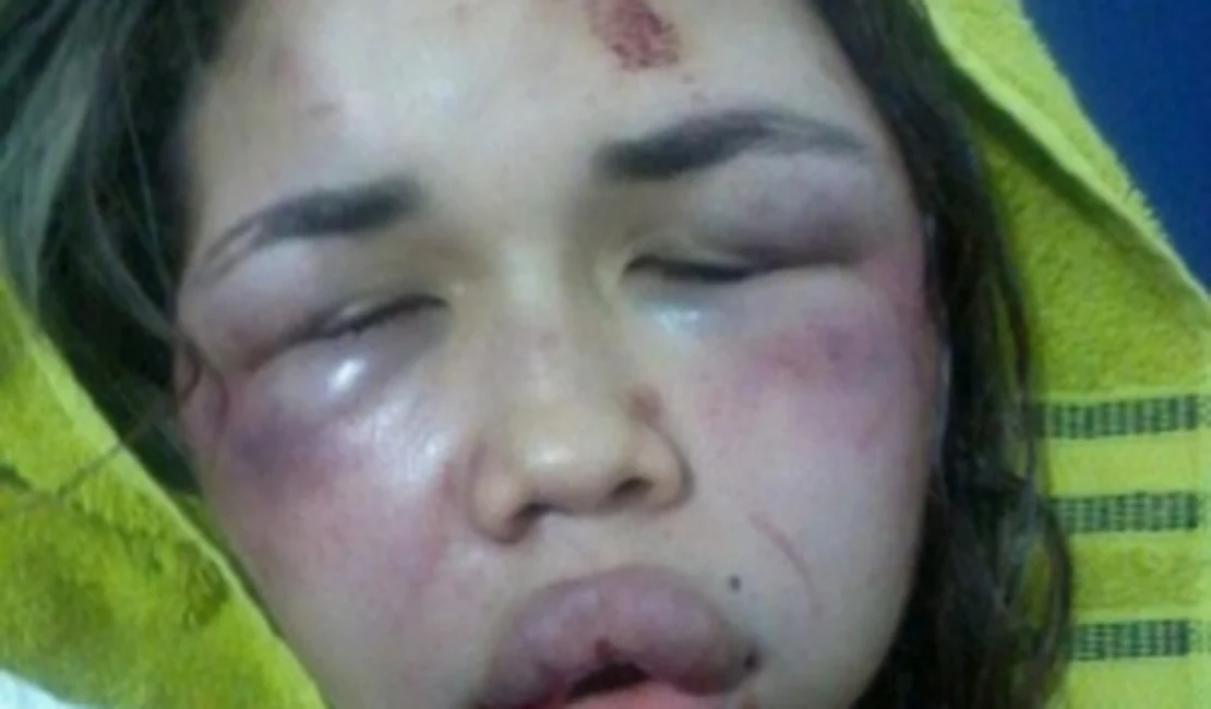 Após ser agredida durante assalto, jovem fica com o rosto desfigurado