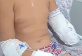 Menino de 10 anos tem parte de braço amputado após acidente em Maribondo