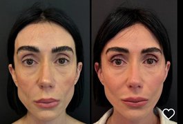 Jornalista alagoana Michelle Barros remove preenchimentos do rosto e revela nova aparência: 'Me sentindo natural'
