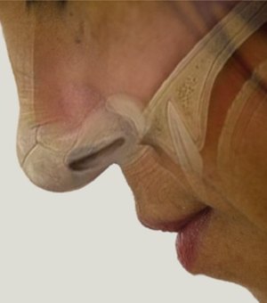 Cirurgia pioneira trata pacientes com perda de olfato causada pela covid-19