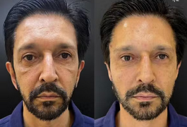 Ricardo Nunes faz harmonização facial, clínica de estética publica 'antes e depois', mas apaga post