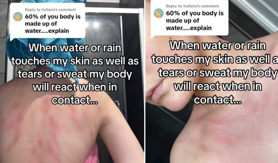 Jovem alérgica a água conta que sente dores intensas após contato com o líquido; entenda