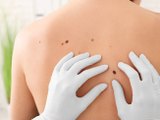 Dia Global alerta para prevenção e diagnóstico precoce do câncer de pele não melanoma