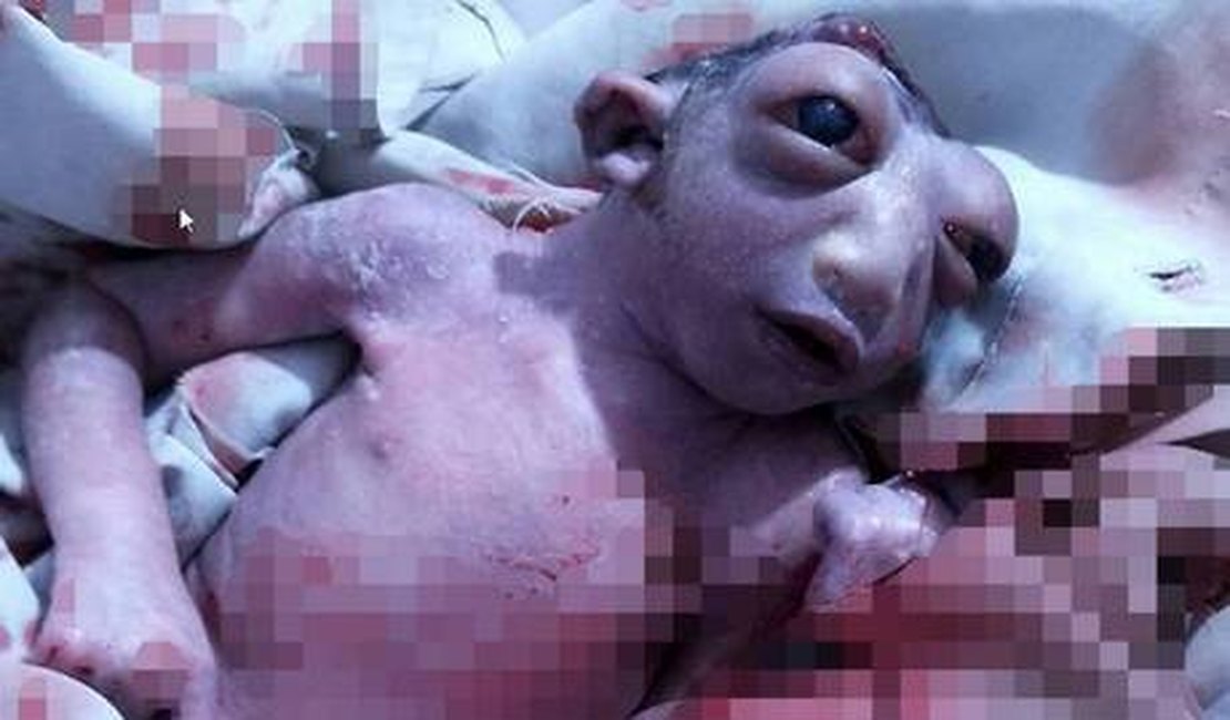 Bebê nasce sem metade da cabeça e surpreende os médicos ao viver 48 horas