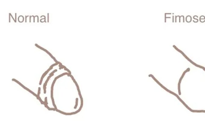 Você tem fimose? O que é a condição que transforma o sexo em agonia para milhares de homens
