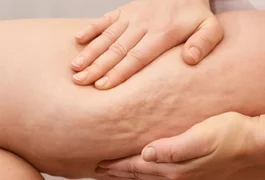 “Celulite de TPM”: por que os furinhos podem parecer mais evidentes antes da menstruação?
