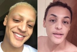 Pabllo Vittar mostra o resultado da cirurgia no nariz: 'Ficou bafo'