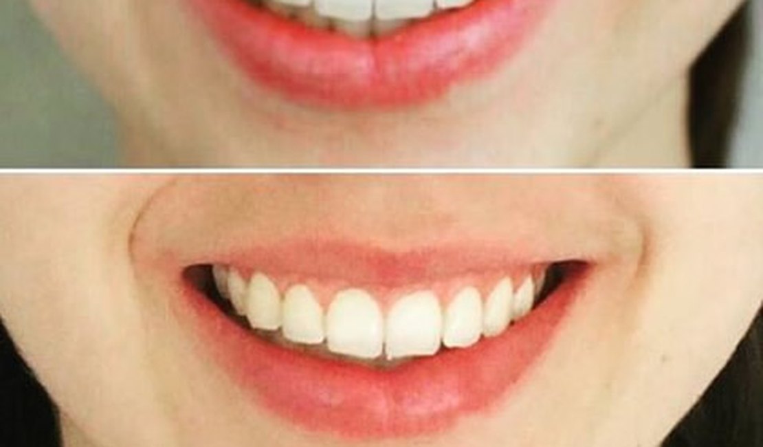 Saiba mais sobre cirurgia plástica periodontal