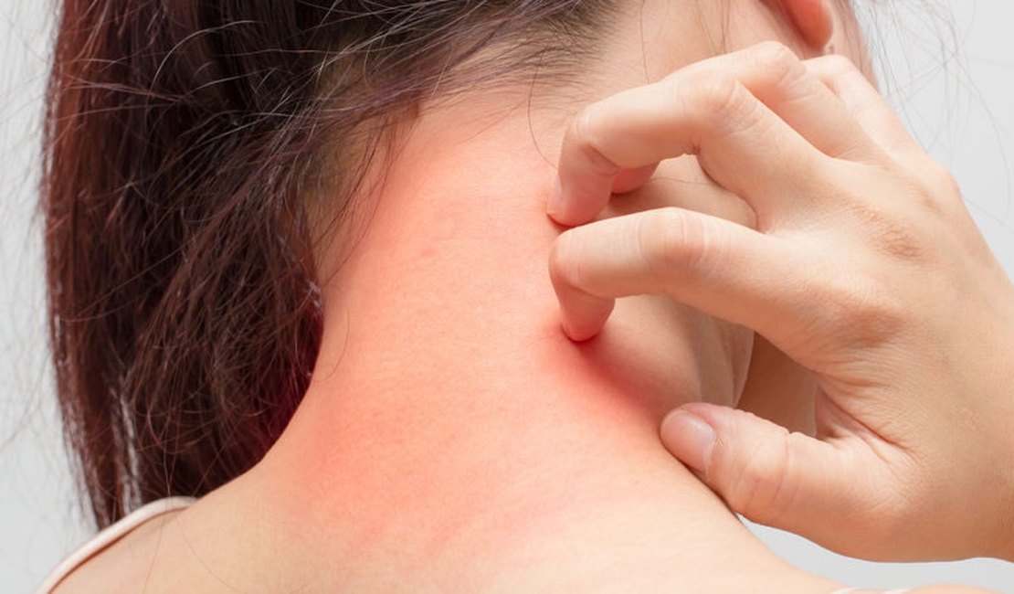 Você sabia que a ansiedade pode agravar os quadros de Dermatite Atópica?