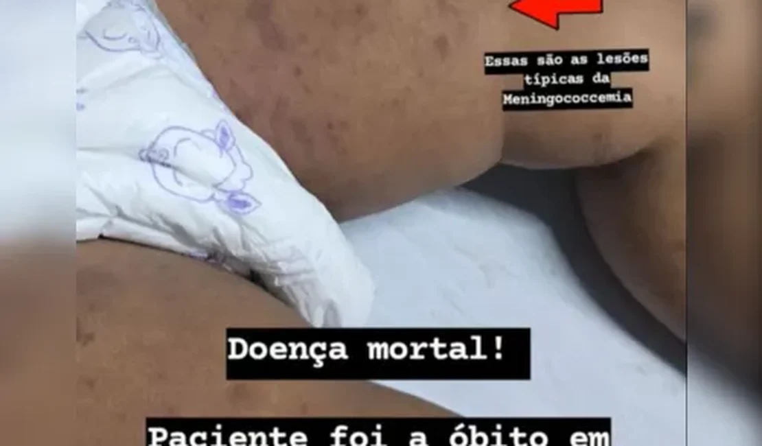 Após 19 casos e cinco mortes por meningite  registradas só em 2024, Ministério da Saúde irá intervir em Maceió