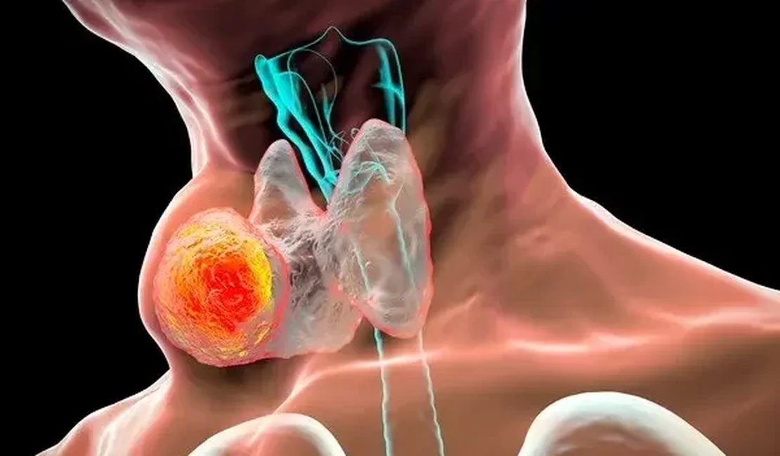 ANS inclui tratamento de câncer de tireoide na cobertura obrigatória