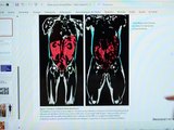 Como identificar a gordura visceral? Medida da cintura pode indicar risco