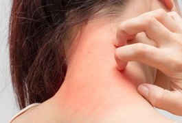 Você sabia que a ansiedade pode agravar os quadros de Dermatite Atópica?