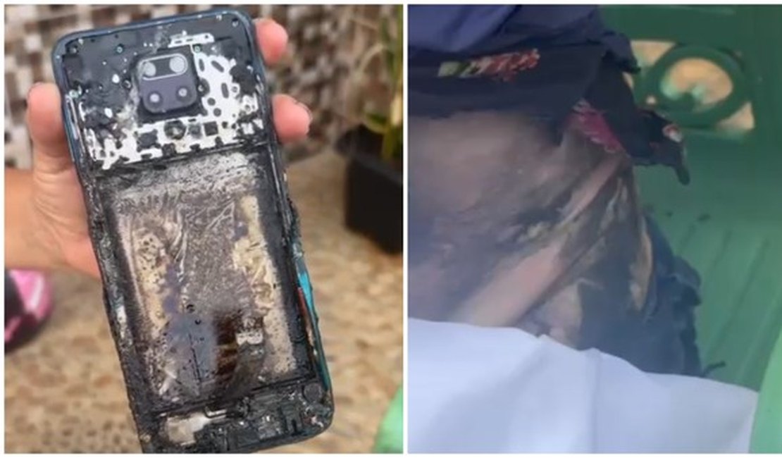 Técnica de enfermagem sofre queimaduras graves após celular pegar fogo, enquanto ela andava de moto