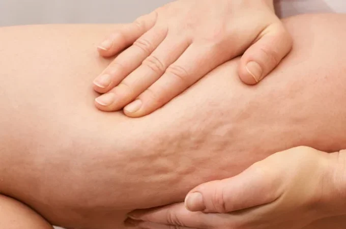 “Celulite de TPM”: por que os furinhos podem parecer mais evidentes antes da menstruação?