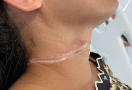 Fiação de internet solta de poste, causa acidente e deixa jovem ferida, no Sertão