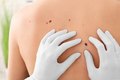 Dia Global alerta para prevenção e diagnóstico precoce do câncer de pele não melanoma