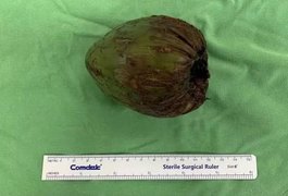 Homem é socorrido para o hospital após introduzir um coco no ânus